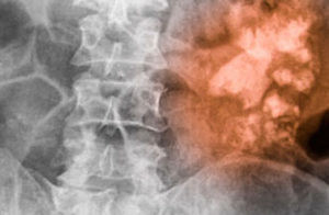 Radiografia da coluna lombar e região abdominal mostrando, à direita, uma área avermelhada que destaca alterações no rim, sugerindo inflamação ou comprometimento da função renal.