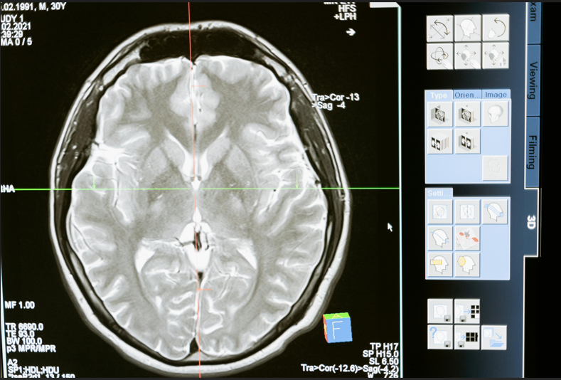 "Imagem de ressonância magnética cerebral destacando estruturas do encéfalo, utilizada para diagnósticos neurológicos e estudos clínicos.